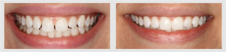 Before and After - Glenlake Dental Care