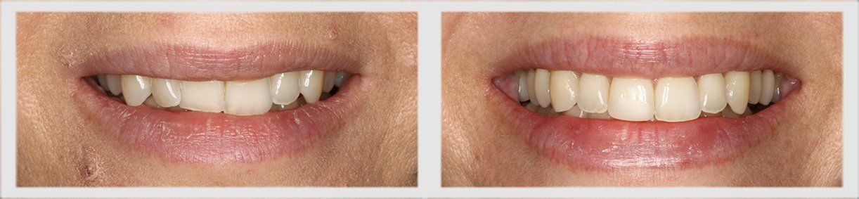 Before and After - Glenlake Dental Care