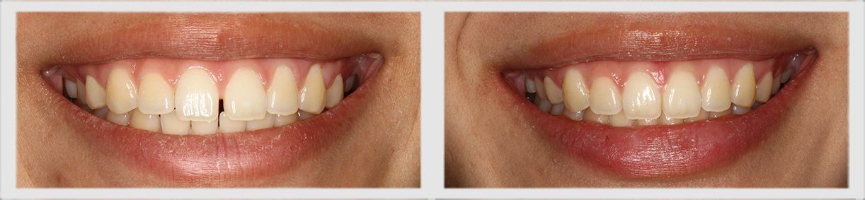 Before and After - Glenlake Dental Care