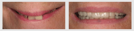 Before and After - Glenlake Dental Care