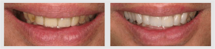 Before and After - Glenlake Dental Care