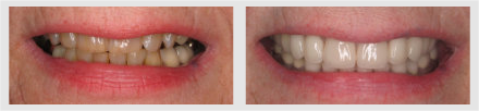 Before and After - Glenlake Dental Care