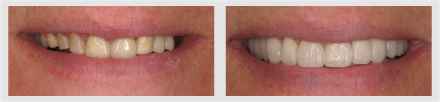 Before and After - Glenlake Dental Care