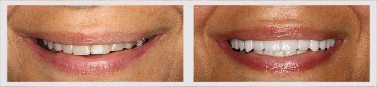 Before and After - Glenlake Dental Care