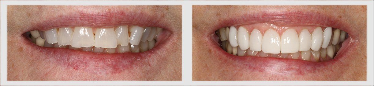 Before and After - Glenlake Dental Care