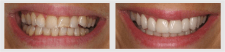Before and After - Glenlake Dental Care