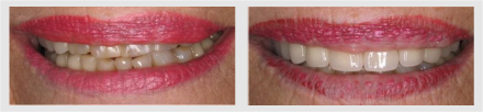 Before and After - Glenlake Dental Care