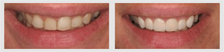 Before and After - Glenlake Dental Care