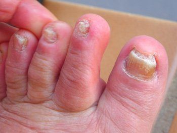 Fungal Toenails — Patient Having Fungal Toenails in Orlando, FL Fungal Toenails — Patient Having Fungal Toenails in Orlando, FL