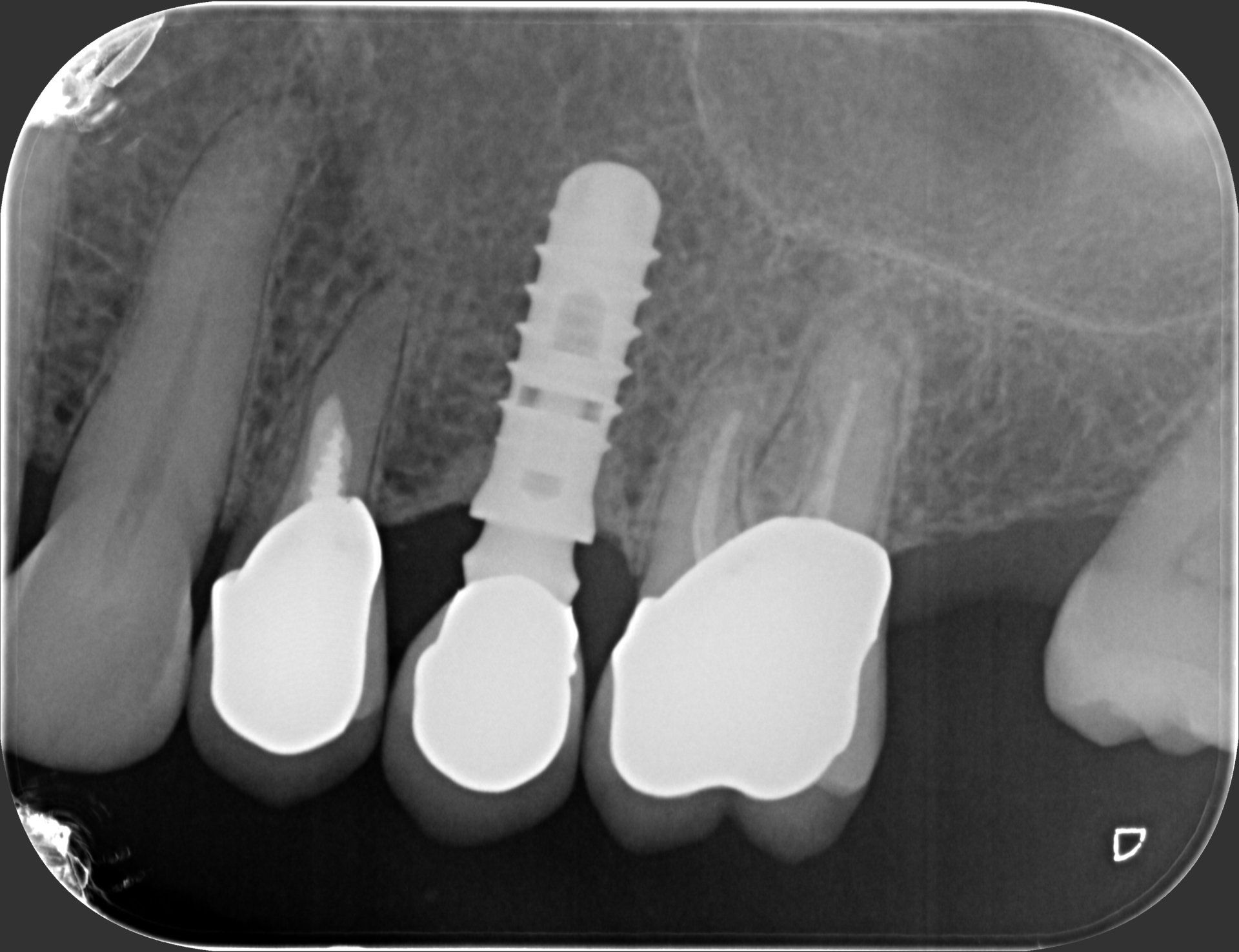 radiografia dentale dopo