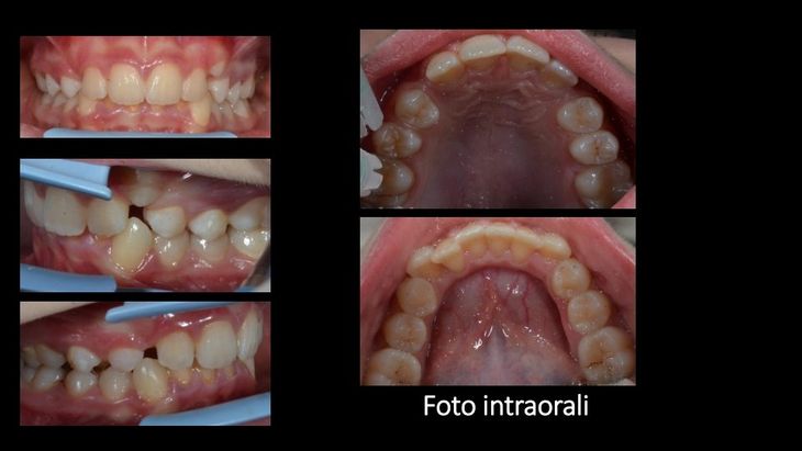 impianti dentali