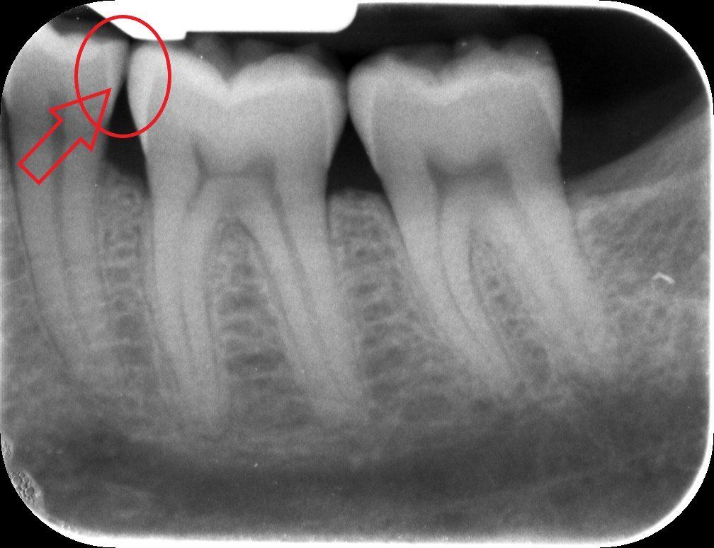 denti molari