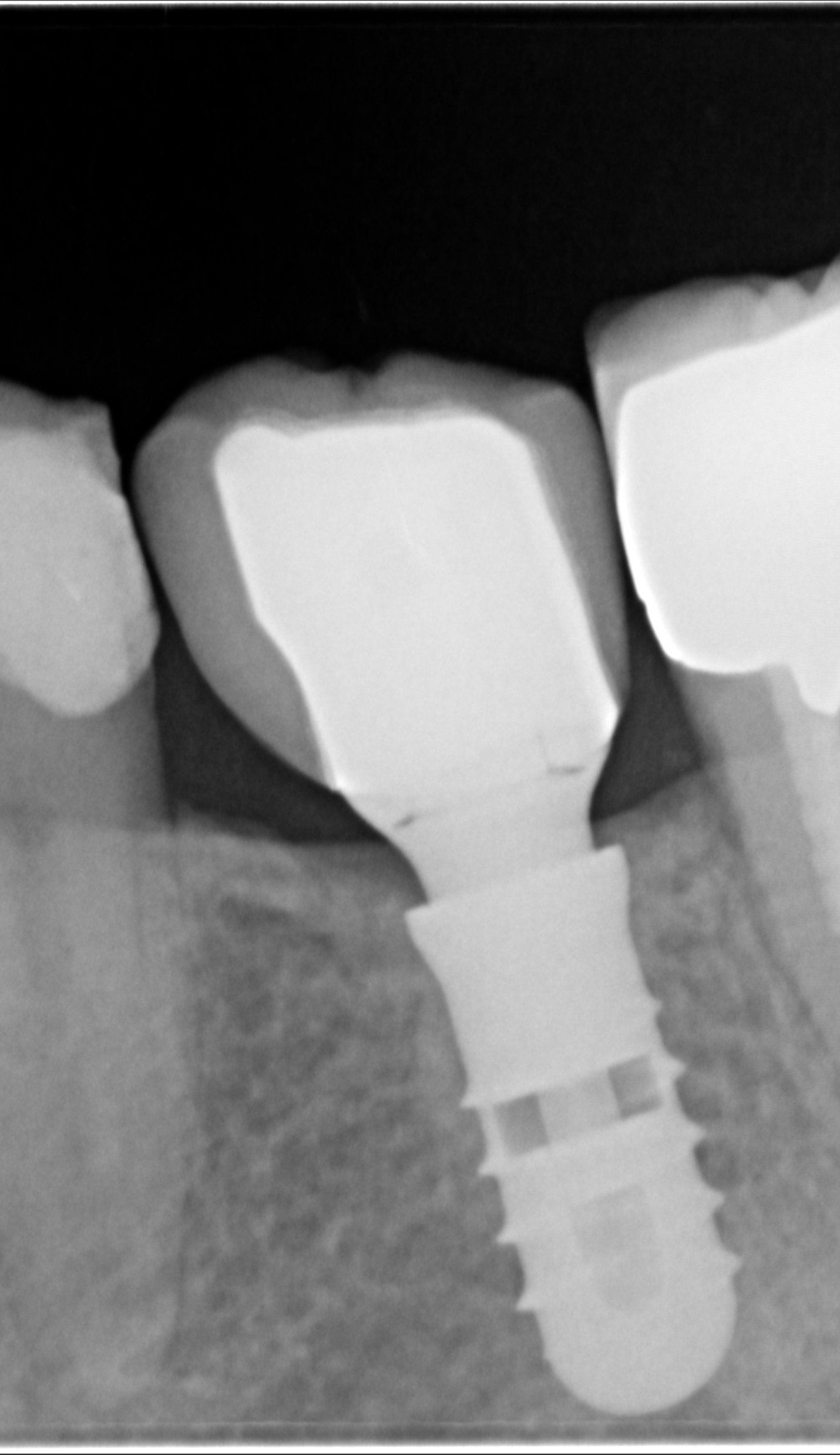radiografia dentale dopo
