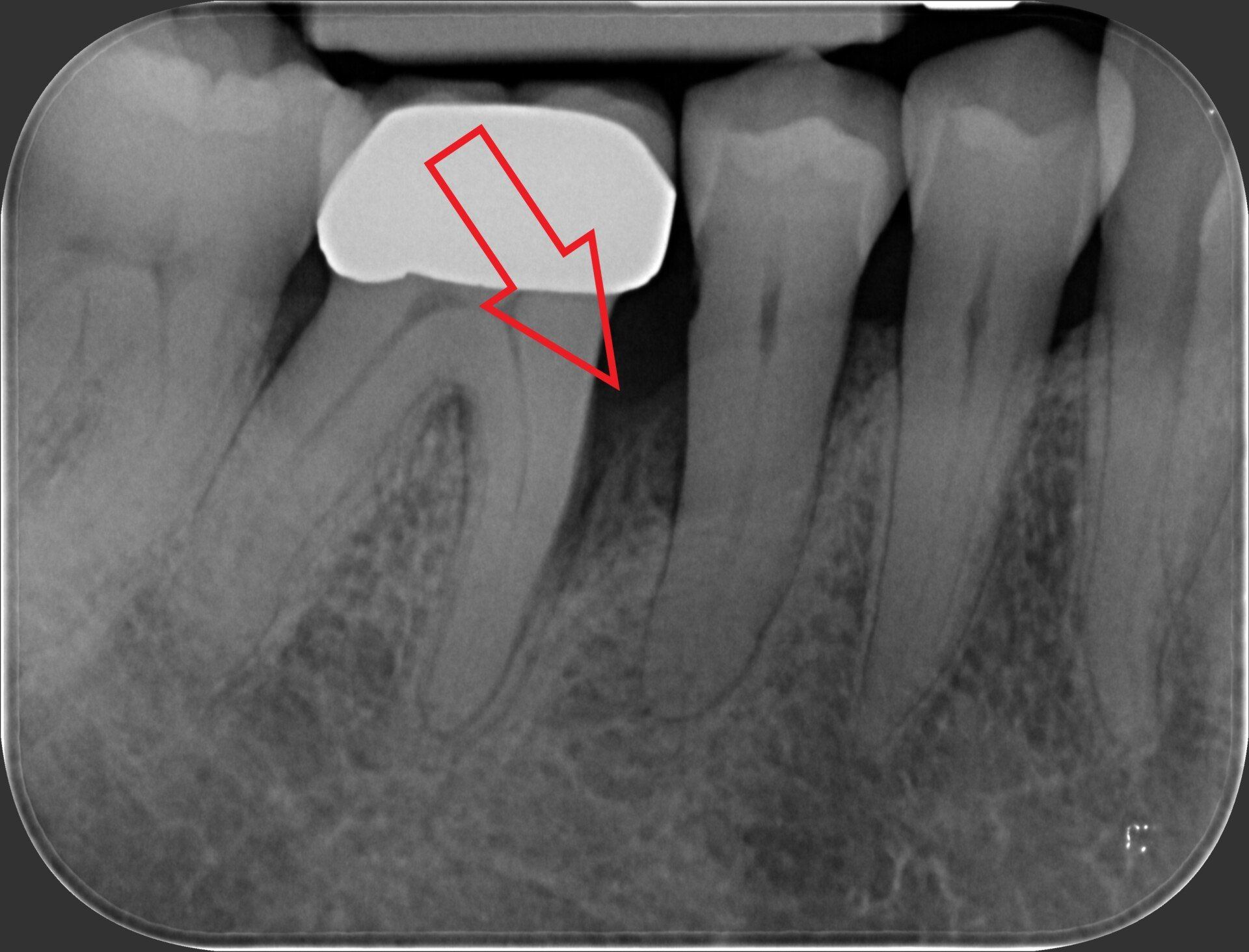 radiografia molari dopo