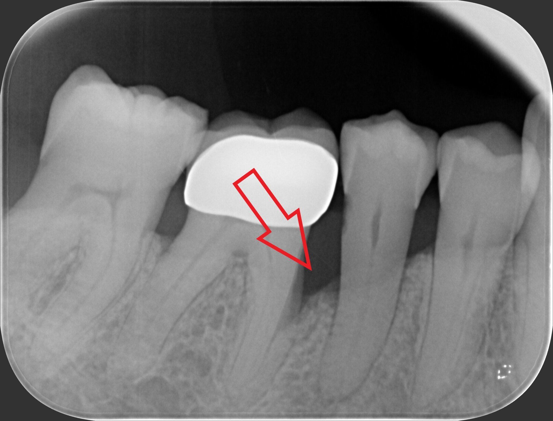 radiografia molari prima