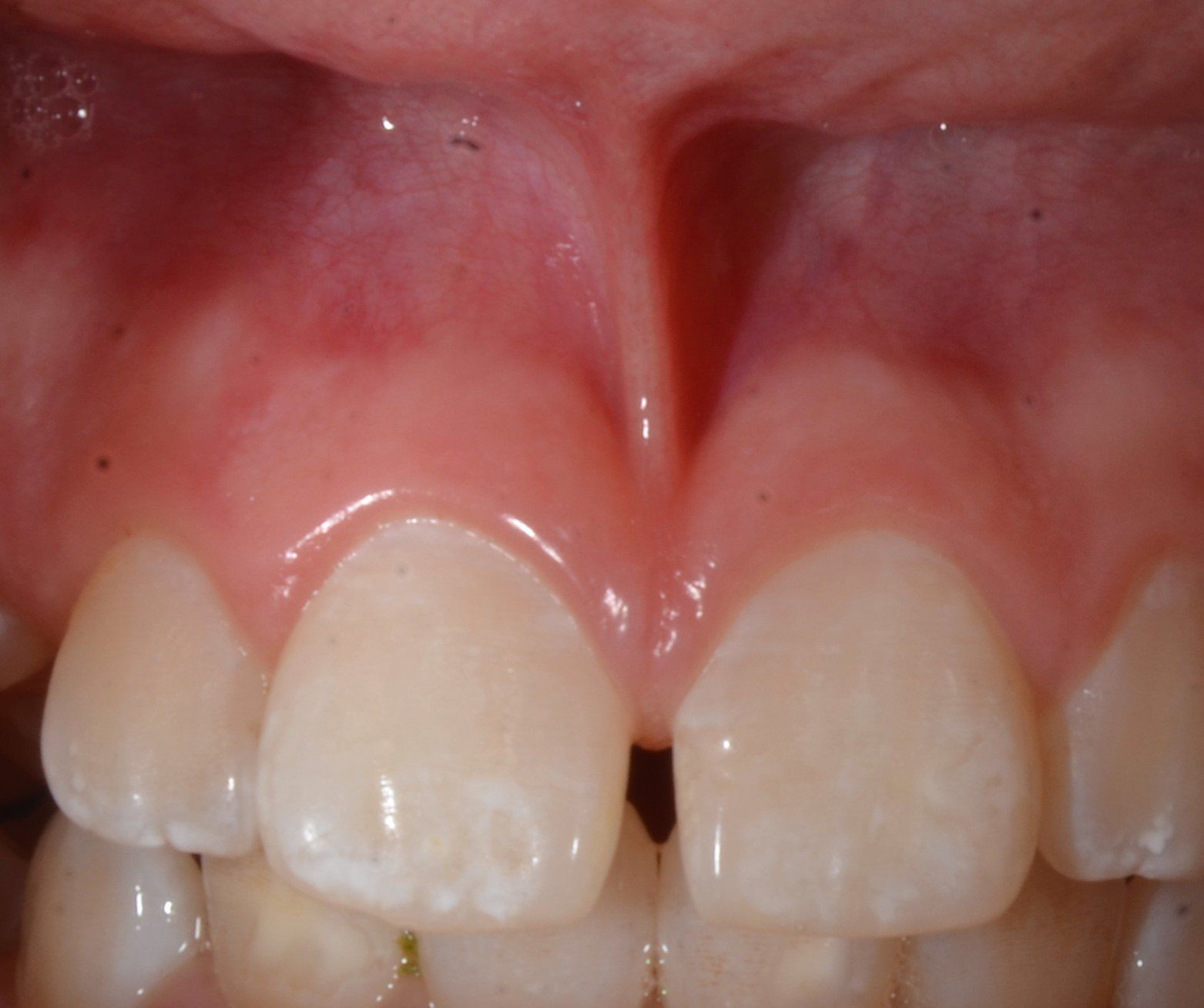 denti prima del trattamento