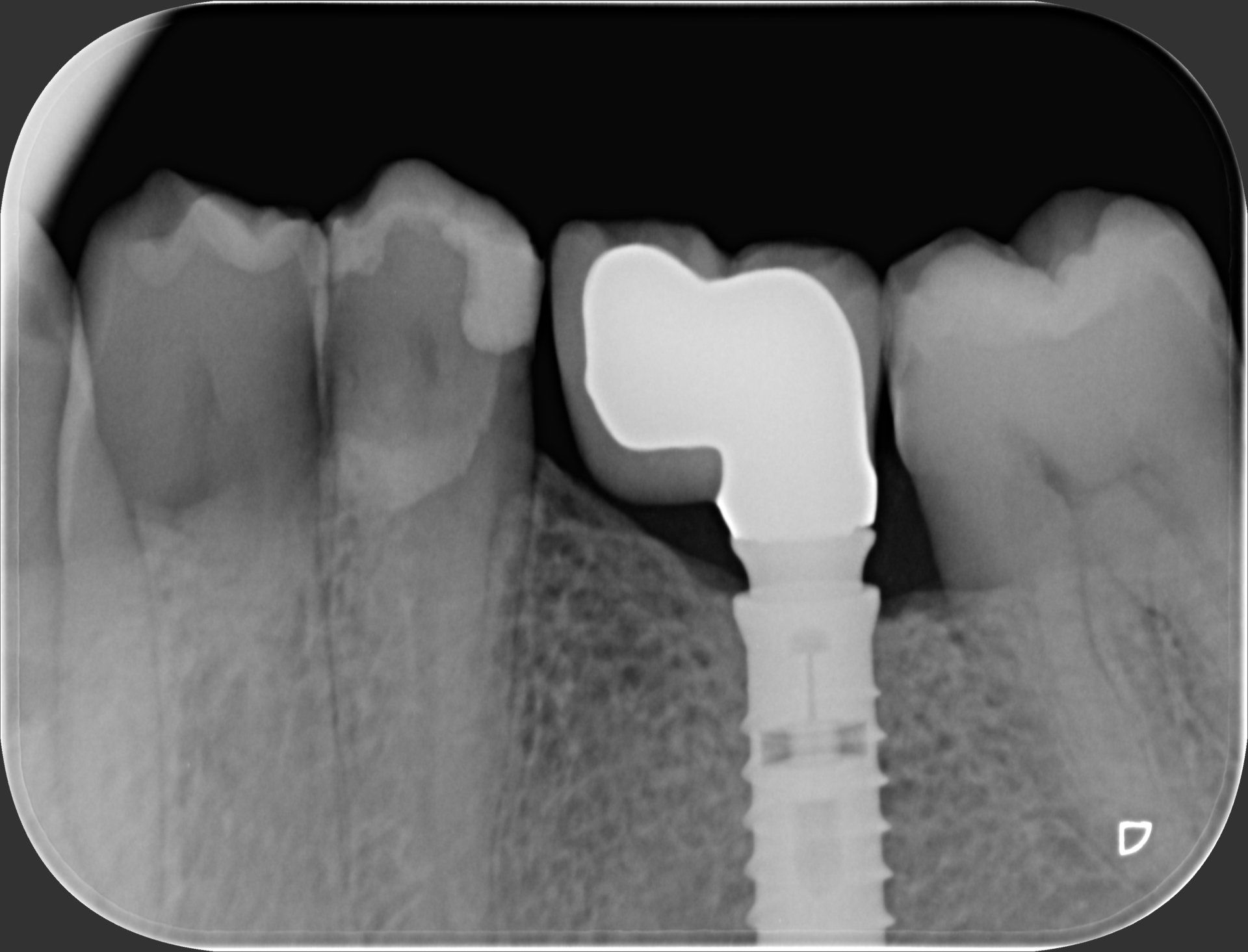 impianto dentale dopo