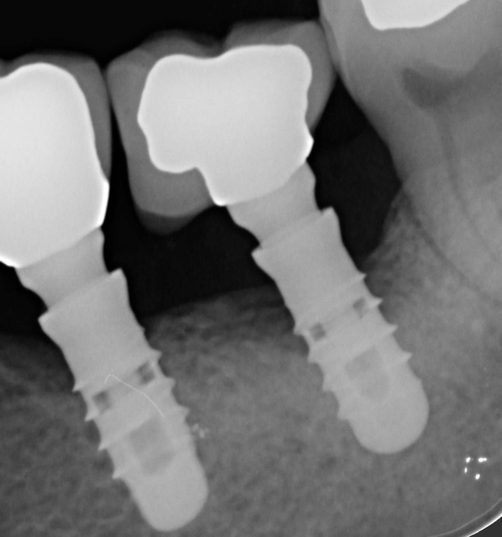 impianti dentali dopo