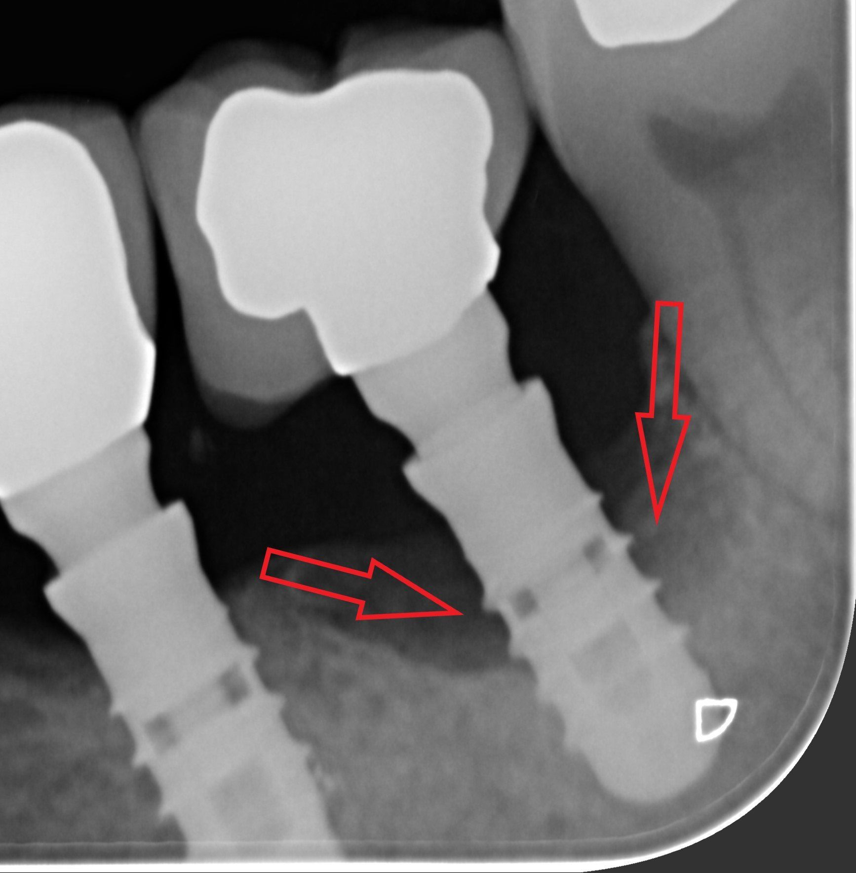 impianti dentali prima
