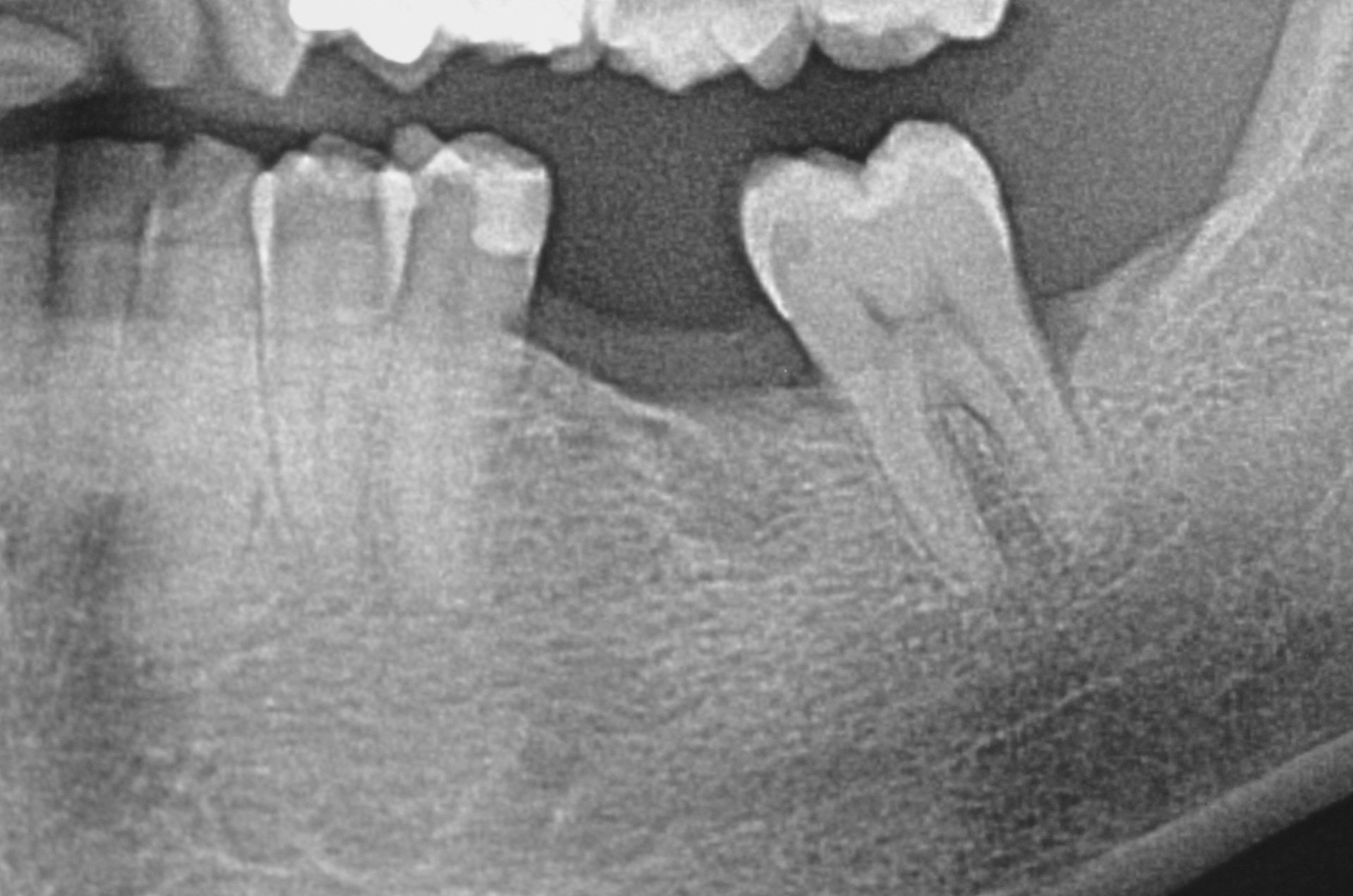 impianto dentale prima