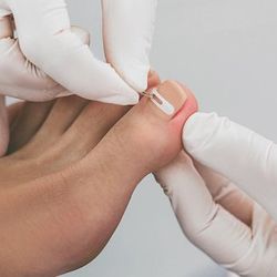 ingrown nail