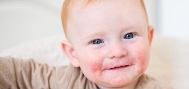 Um bebê com manchas vermelhas no rosto está sorrindo.