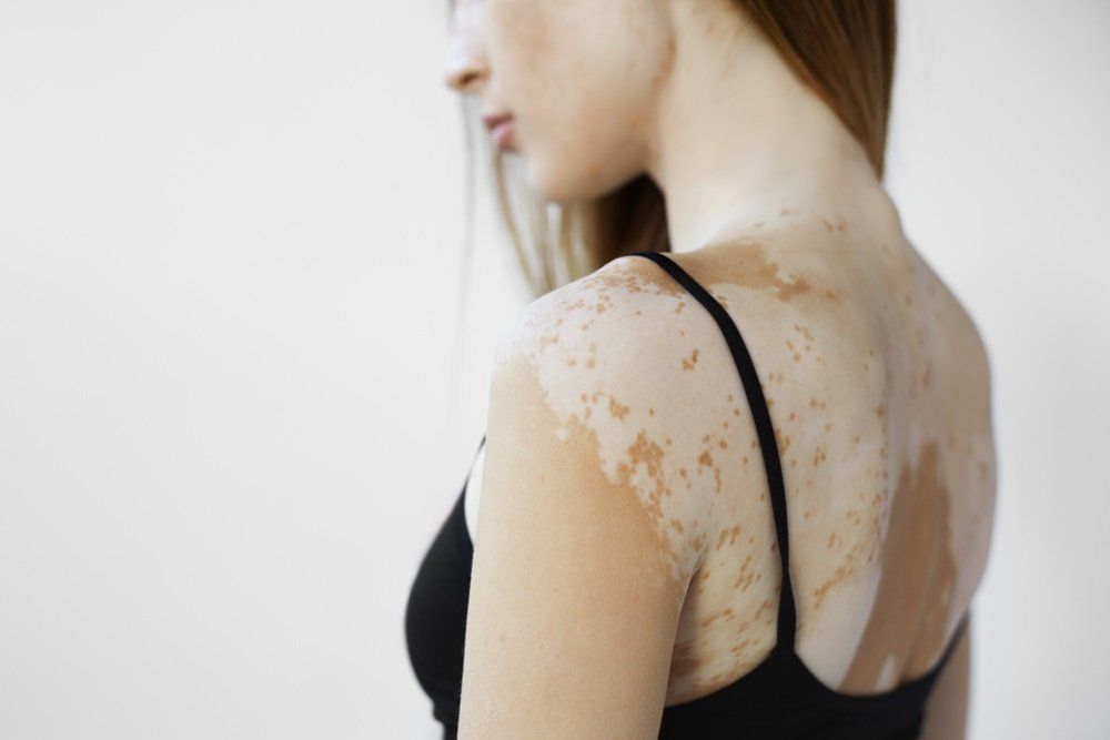 Uma mulher com vitiligo no ombro e nas costas está vestindo uma regata preta.