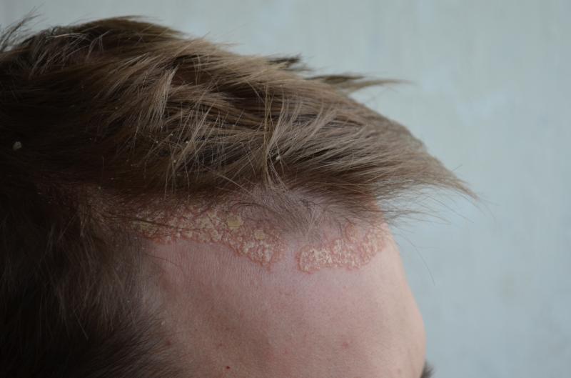 Um close da cabeça de uma pessoa com dermatite atópica.