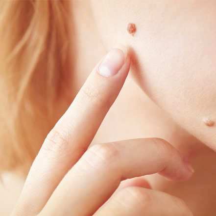 Mapeamento corporal de pintas feito com dermatologista