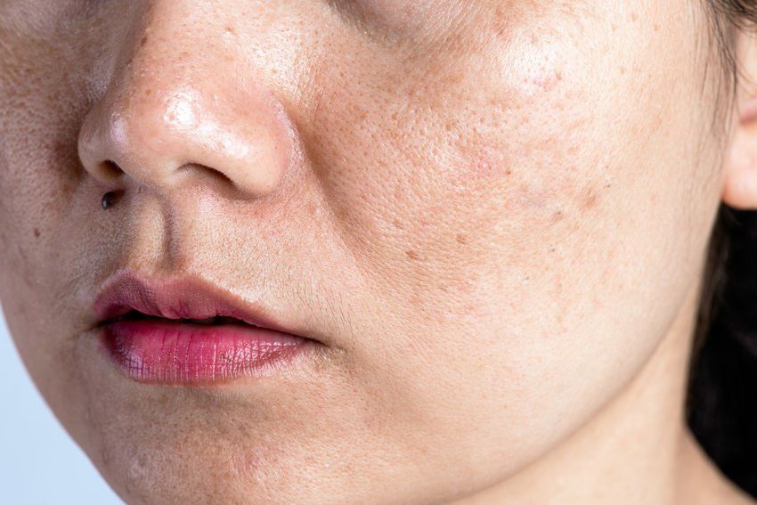 Um close do rosto de uma mulher com melasma.