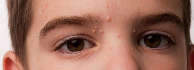 Um close do rosto de um menino com acne na testa.
