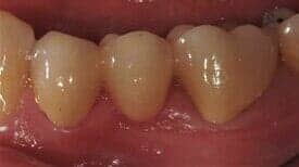 Porcelain bridges after — Dental Office in Virginia Beach, VA