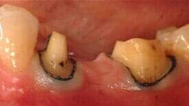 Porcelain Bridges before — Dental Office in Virginia Beach, VA