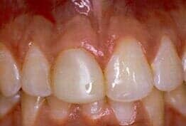 Porcelain Crowns before — Dental Office in Virginia Beach, VA