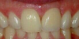 Dental Implants after — Dental Office in Virginia Beach, VA