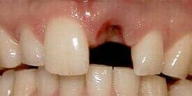 Dental Implants before — Dental Office in Virginia Beach, VA
