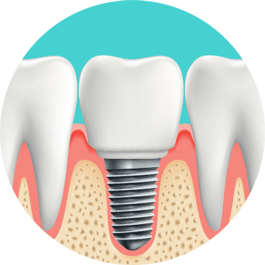 implants