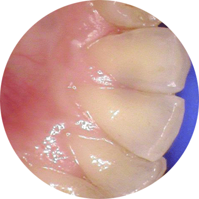 tooth colored fillings