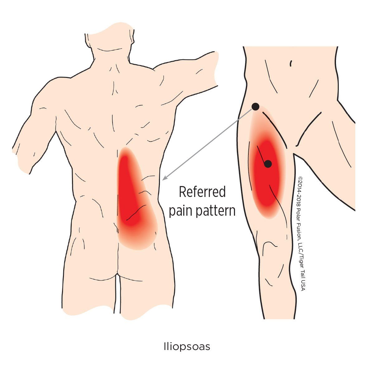 A drawing of a man with a referred pain pattern