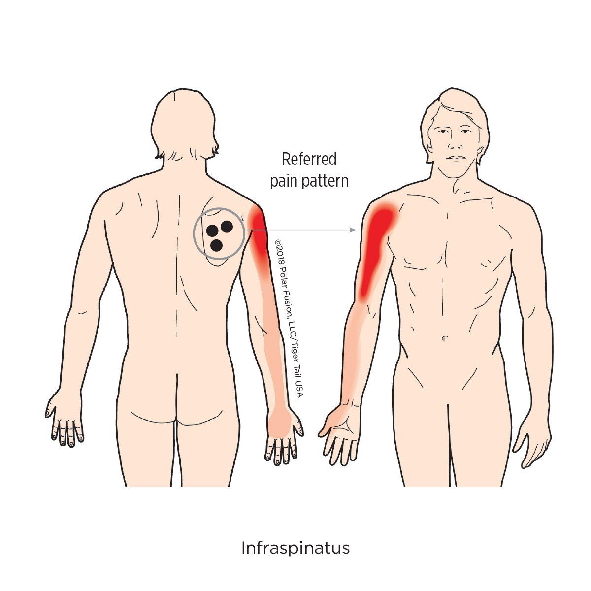 A drawing of a man with a referred pain pattern in his arm.