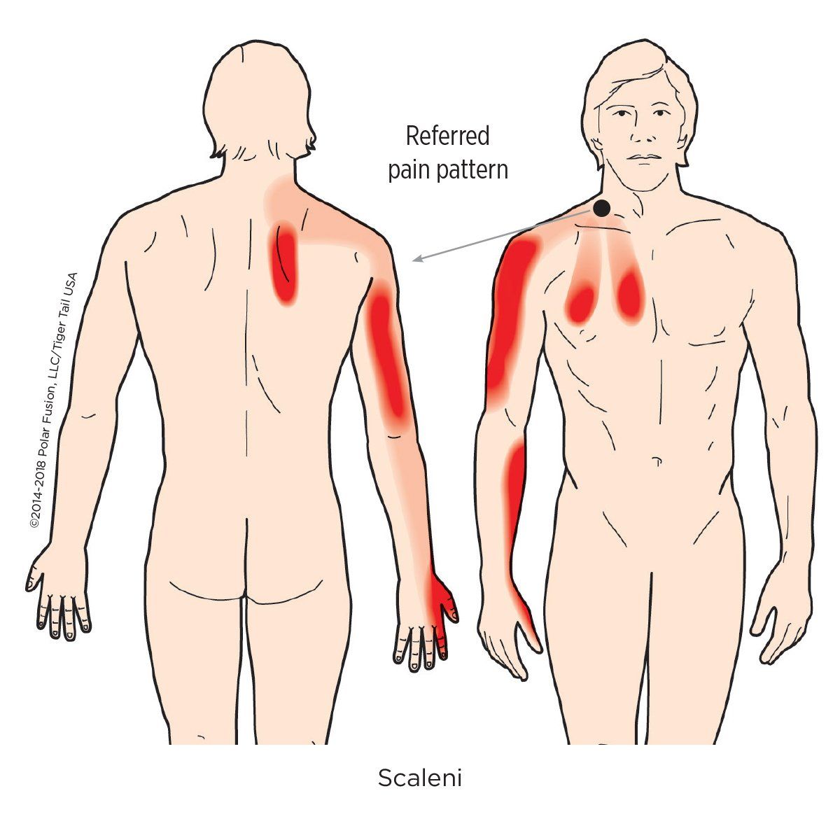 A drawing of a man with a referred pain pattern