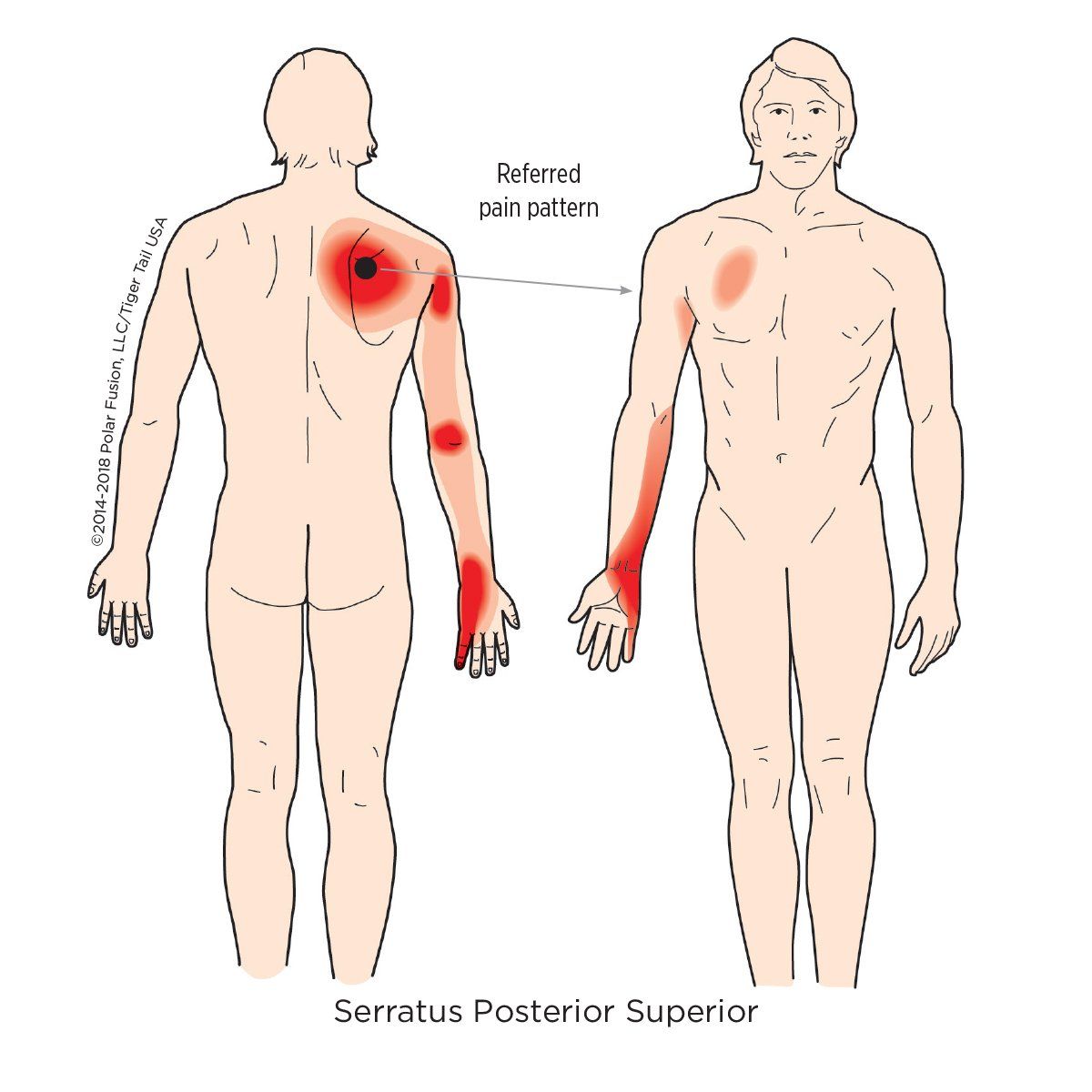 A diagram of a man 's body showing the location of the serratus posterior superior muscle.