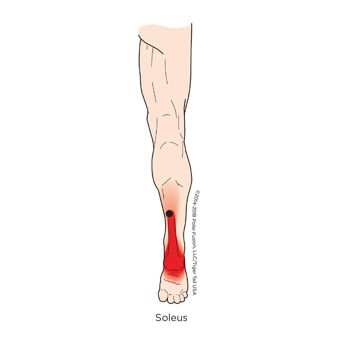 A drawing of a person 's leg with a red spot on the soleus.
