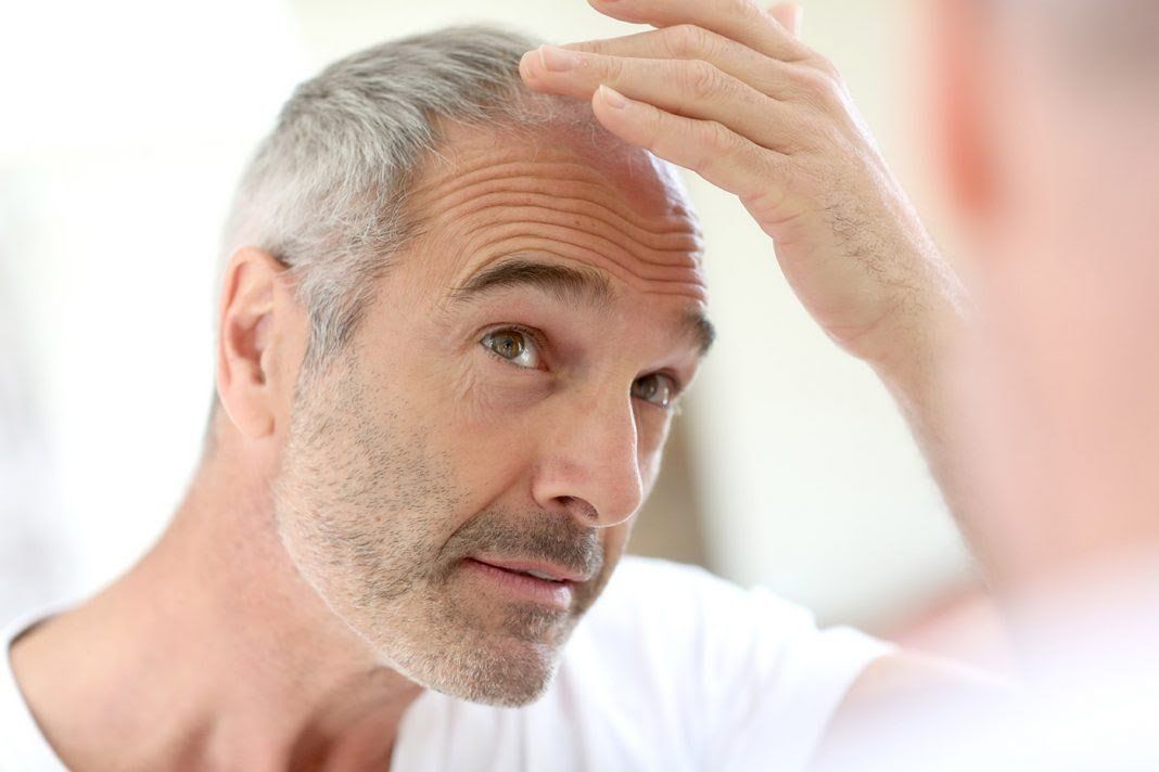 Alopecia