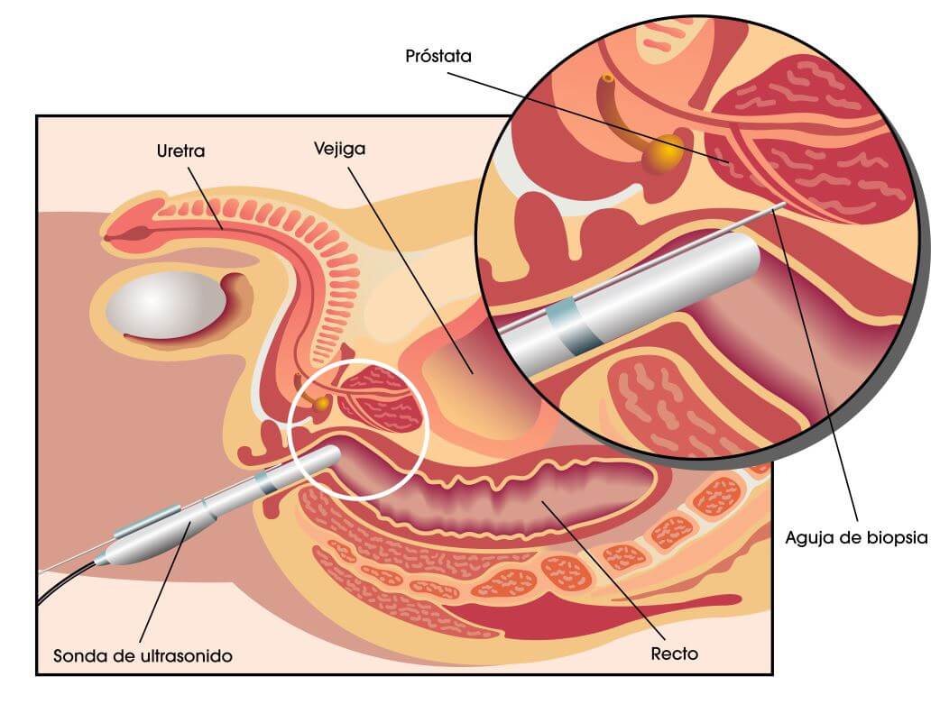 Toma de biopsia de la Próstata