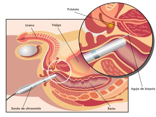 Biopsia de próstata