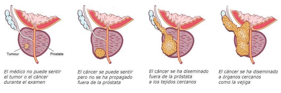 Diseminación del cáncer en la próstata