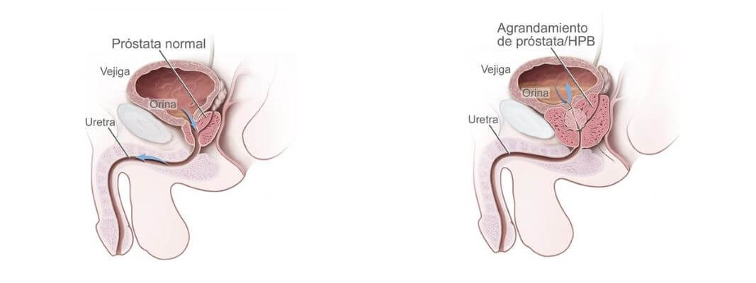 Próstata normal vs próstata con agrandamiento