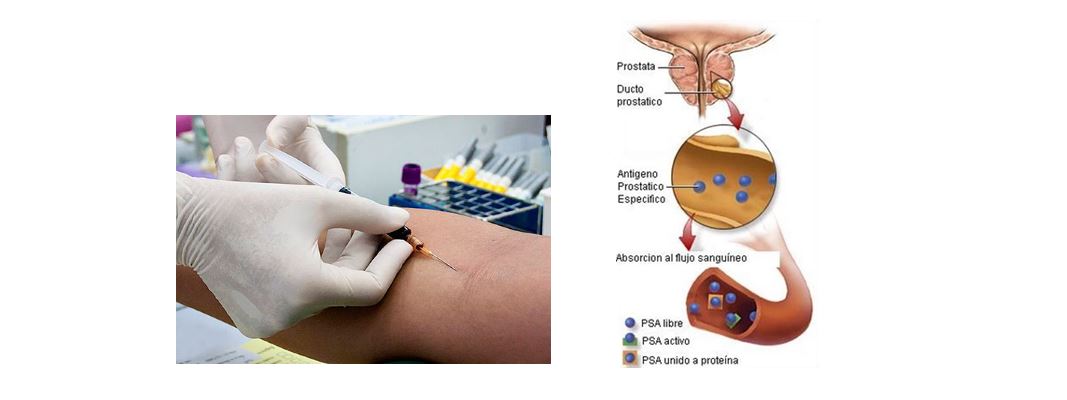 Prueba de antígeno prostático específico (APE)