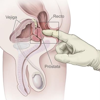 Tacto rectal próstata (TR)